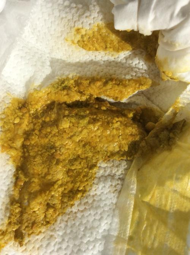 顺产5天没有大便怎么办 顺产5天没有大便怎么办