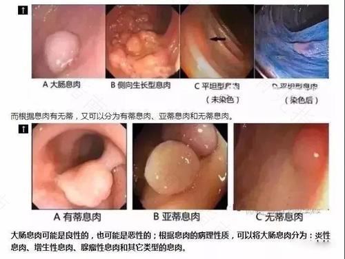 结肠息肉切除后便秘怎么回事