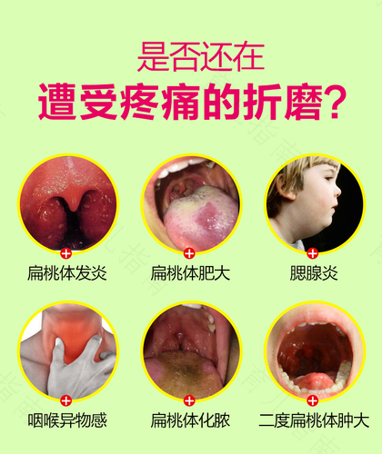 喉咙有点发炎咳嗽怎么办 喉咙有点发炎咳嗽怎么办
