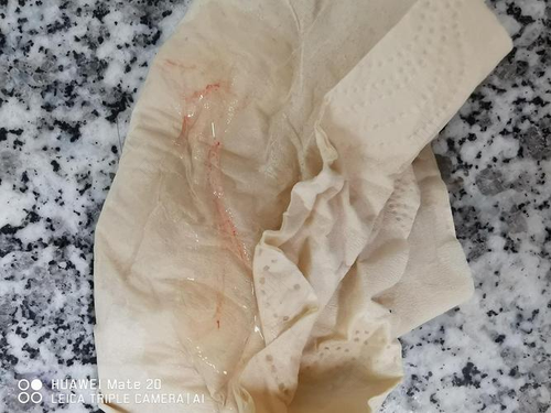 女性分泌物有血怎么回事 女性分泌物有血怎么回事