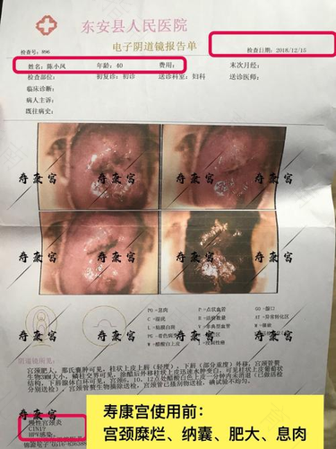 宫颈糜烂跟hpv有关吗