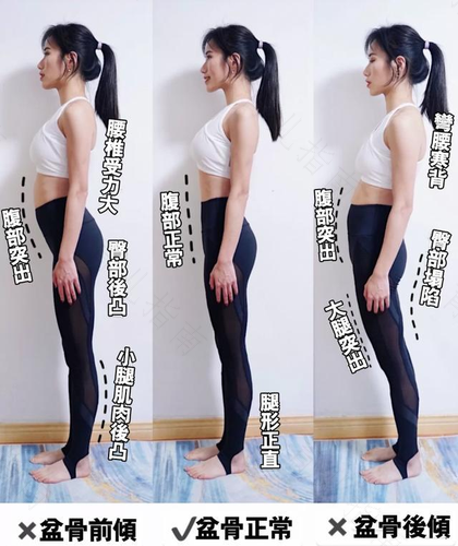 如何自测是否骨盆前倾 如何自测是否骨盆前倾