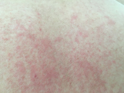 身上起热疹子怎么办 身上起热疹子怎么办