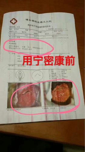 宫颈上纳氏囊肿需要做手术吗 宫颈上纳氏囊肿需要做手术吗