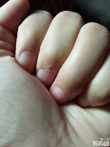 手指上面有倒刺怎么办