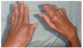 类风湿关节炎关节发热是什么症状 类风湿关节炎关节发热是什么症状