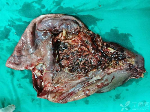 女性肝上有囊肿严重吗 女性肝上有囊肿严重吗