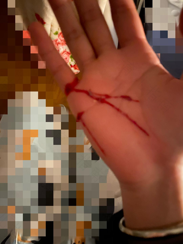 1mm深伤口要打破伤风么 1mm深伤口要打破伤风么