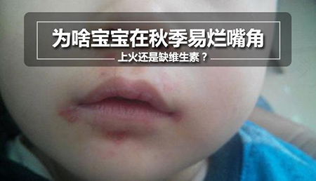 上火不治疗最严重会怎么样 上火不治疗最严重会怎么样