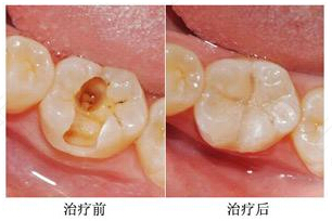牙齿上有洞还痛怎么办 牙齿上有洞还痛怎么办