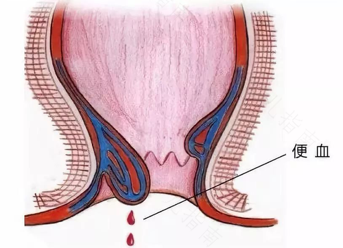 痣疮有血怎么回事