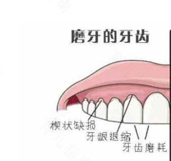 大人睡觉时磨牙是什么原因引起的 大人睡觉时磨牙是什么原因引起的