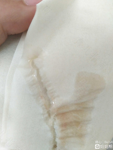 突然尿出血怎么办 突然尿出血怎么办