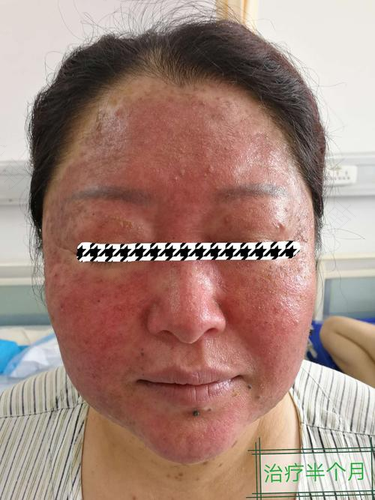 丘疹性皮炎怎么治疗最彻底