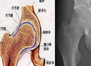 女性左侧股骨头痛是什么原因 女性左侧股骨头痛是什么原因