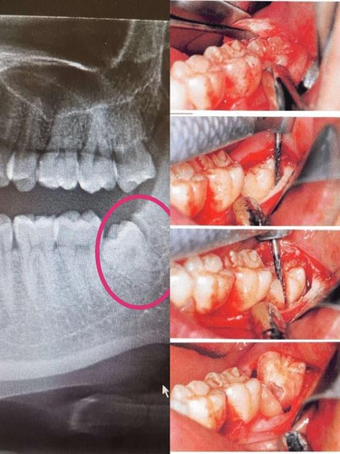 拔牙会伤到神经吗 拔牙会伤到神经吗