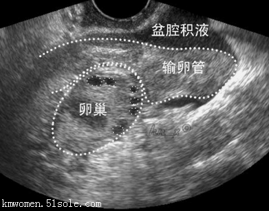 女性腹腔积液是什么原因引起的 女性腹腔积液是什么原因引起的