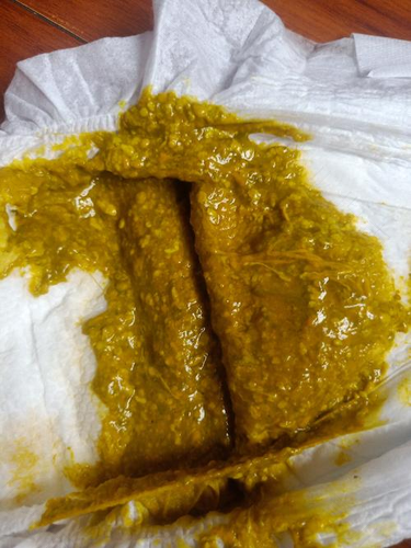 拉粘液大便是怎么回事 拉粘液大便是怎么回事