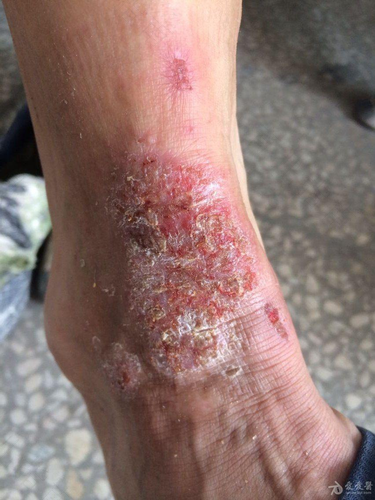 慢性湿疹一直不好怎么办 慢性湿疹一直不好怎么办