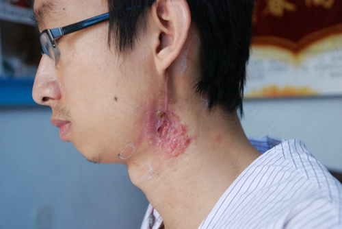 淋巴结核反复复发怎么办 淋巴结核反复复发怎么办