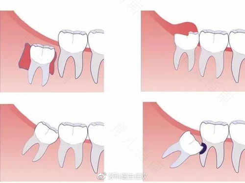牙齿上火和发炎的区别 牙齿上火和发炎的区别