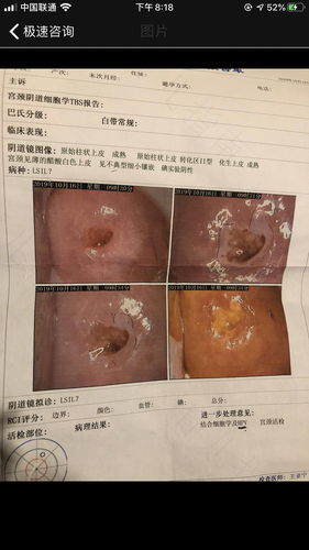 宫颈活检一般什么时候做好 宫颈活检一般什么时候做好