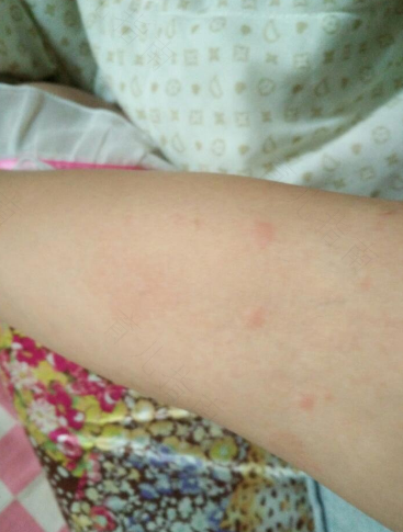 大人脸上湿疹怎么治才能好 大人脸上湿疹怎么治才能好