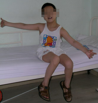 什么是脑瘫? 什么是脑瘫?