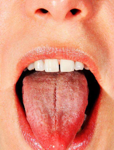 女性舌苔有裂纹是怎么回事 女性舌苔有裂纹是怎么回事