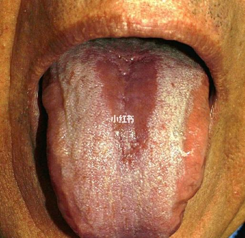 舌苔有锯齿是怎么回事 舌苔有锯齿是怎么回事