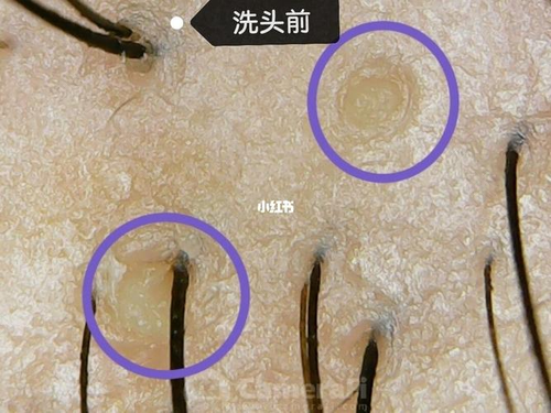 毛囊堵塞是什么原因 毛囊堵塞是什么原因