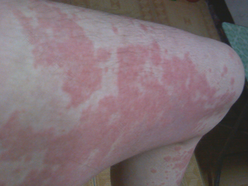 慢性荨麻疹怎么治才能好 慢性荨麻疹怎么治才能好