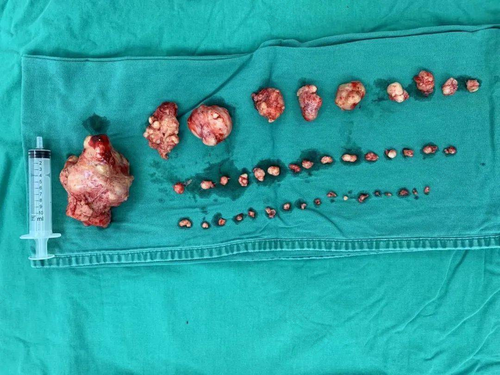 怎样确定子宫肿瘤是恶性还是良性 怎样确定子宫肿瘤是恶性还是良性