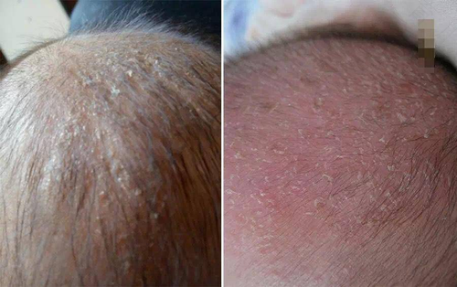 头皮出红疹瘙痒怎么办 头皮出红疹瘙痒怎么办