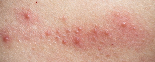 湿疹会不会扩散全身