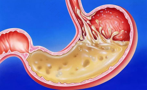 肚子疼胃疼拉水样大便怎么回事 肚子疼胃疼拉水样大便怎么回事