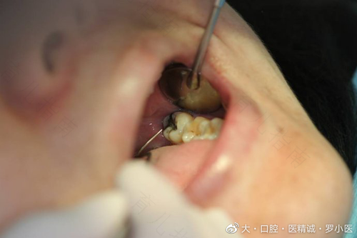 智齿发炎的时候能拔吗? 智齿发炎的时候能拔吗?