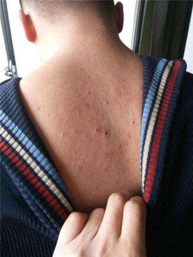 后背老是痒痒怎么回事,但是什么都没有 后背老是痒痒怎么回事,但是什么都没有