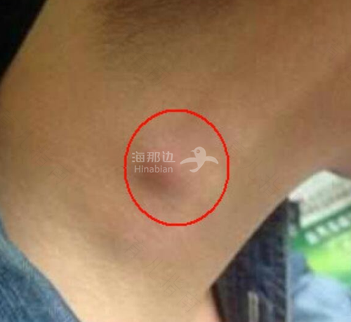 腋窝疼是怎么回事男性 腋窝疼是怎么回事男性