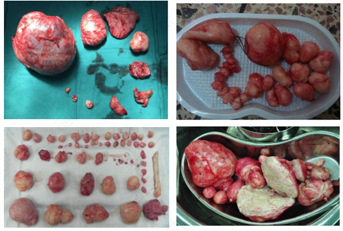 恶性子宫肌瘤有什么症状 恶性子宫肌瘤有什么症状