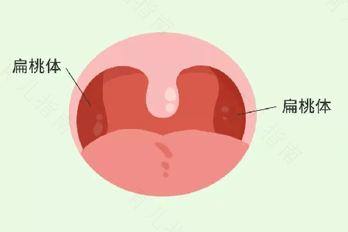 扁桃体可以用手摸到吗 扁桃体可以用手摸到吗
