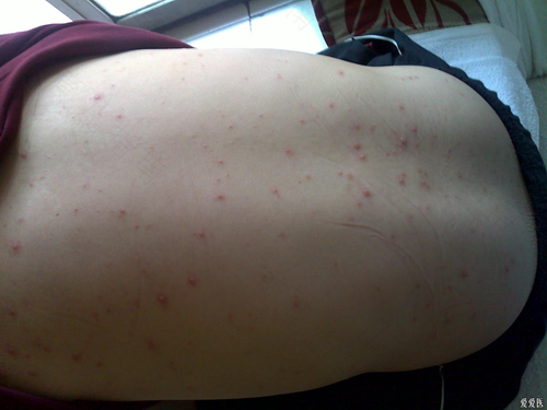 身上长水痘怎么办? 身上长水痘怎么办?