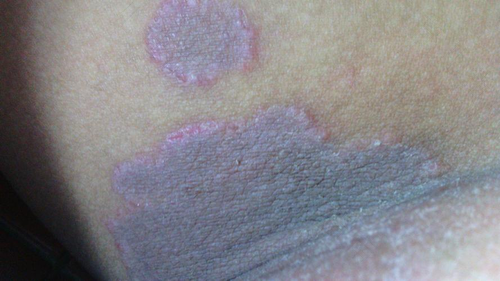 宝宝大腿内侧脱皮怎么办