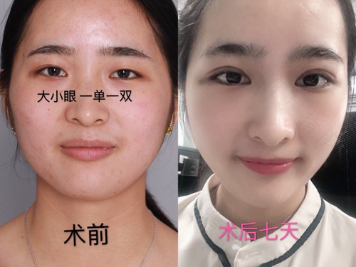 宝宝眼睛一大一小很明显怎么办 宝宝眼睛一大一小很明显怎么办