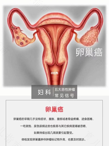 卵巢有积液怎么治疗 卵巢有积液怎么治疗