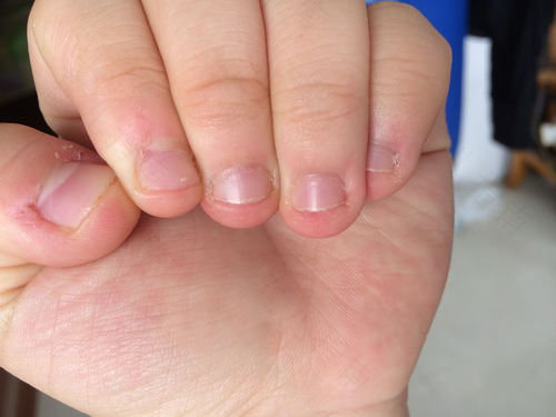 老咬手指甲怎么办 老咬手指甲怎么办