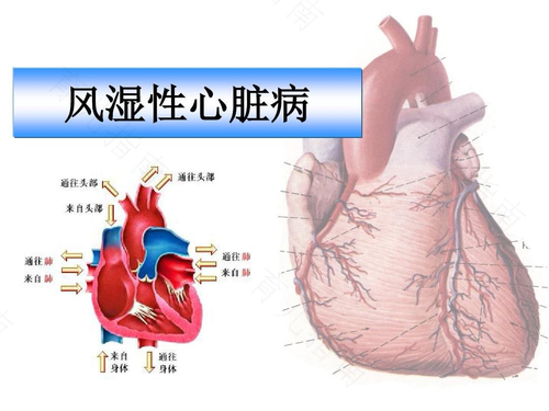 风湿性心脏病症状怎么治疗 风湿性心脏病症状怎么治疗
