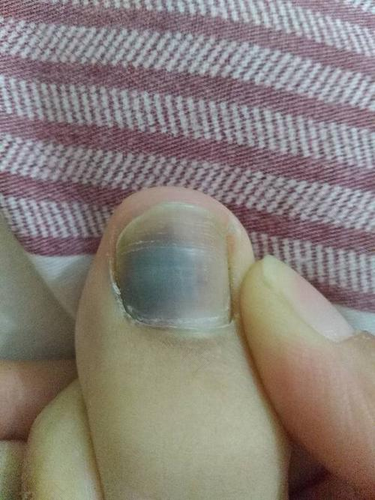 脚指甲里面有淤血咋办 脚指甲里面有淤血咋办