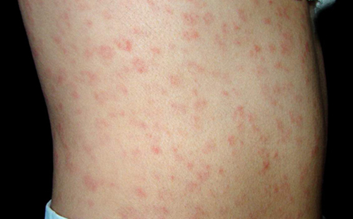 梅毒是怎么样的症状 梅毒是怎么样的症状