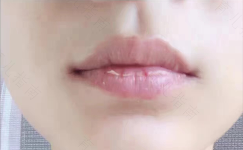 嘴巴总是干起皮怎么回事 嘴巴总是干起皮怎么回事